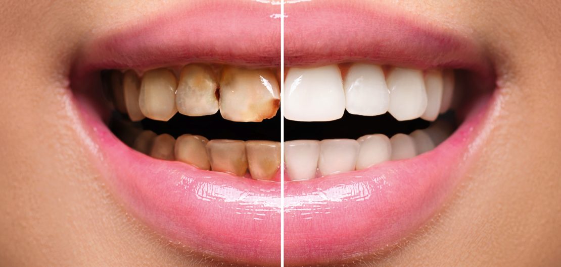 Teeth Cleaning